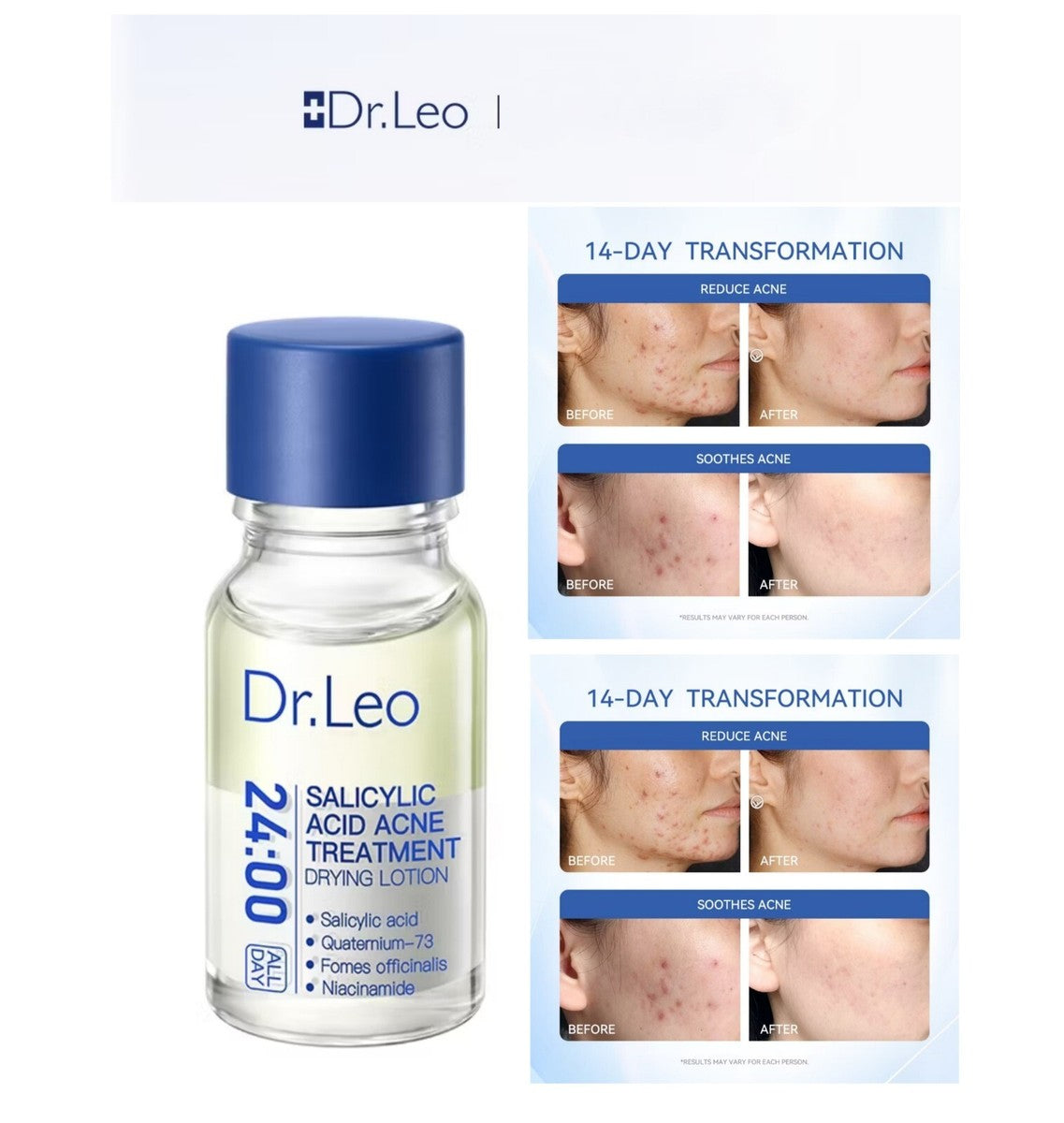 Dr.Leo Salicylic Acid Drying Lotion | 24H Pimple Relief, Fade Acne Marks, Reduce Inflammation, Oil Control, for Sensitive Skin